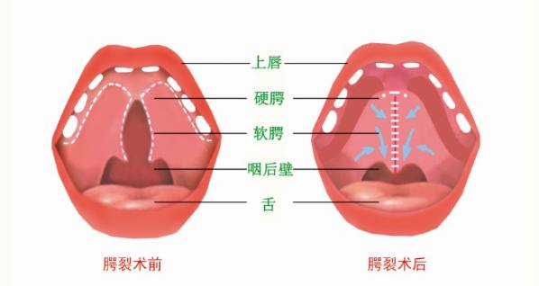 腭裂手術(shù)